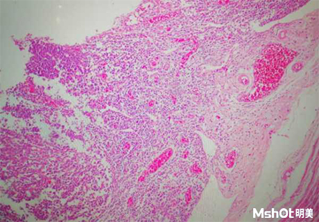 明美顯微鏡相機應用于病理切片檢測
