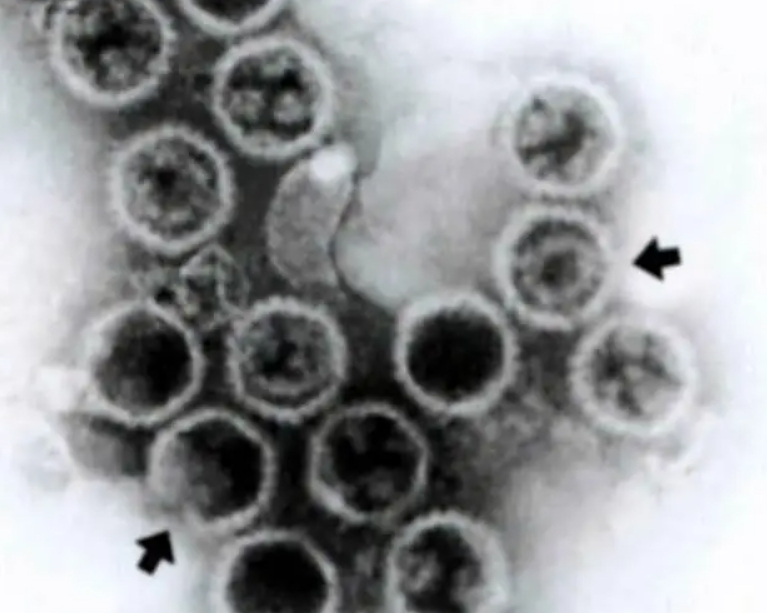 顯微鏡用于皰疹病毒|應用百科